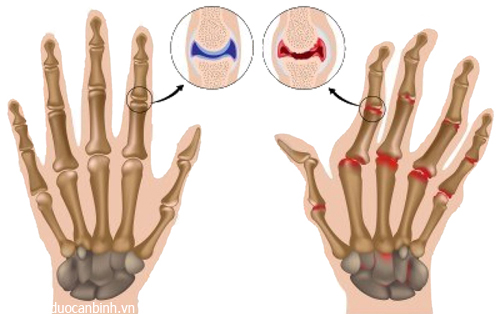 Điều trị thoái hóa khớp ngón tay cổ tay